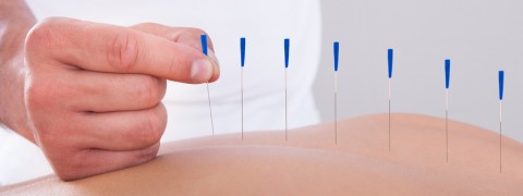 Woman Receiving An Acupuncture Therapy