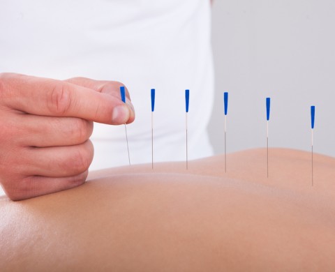 Woman Receiving An Acupuncture Therapy