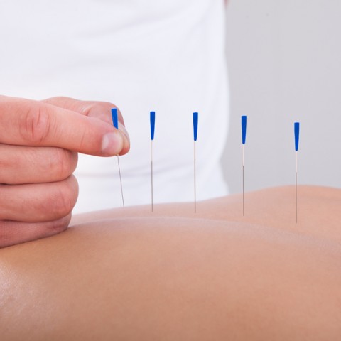 Woman Receiving An Acupuncture Therapy